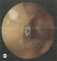 asyrmati-endoskopiki-kapsoula-h1